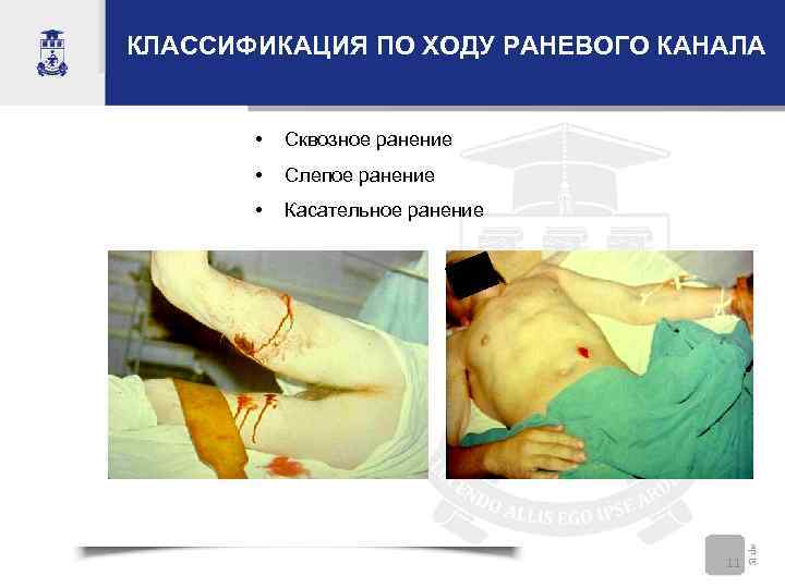 КЛАССИФИКАЦИЯ ПО ХОДУ РАНЕВОГО КАНАЛА • Сквозное ранение • Слепое ранение • Касательное ранение