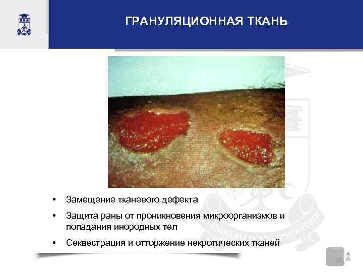 ГРАНУЛЯЦИОННАЯ ТКАНЬ • Замещение тканевого дефекта • Защита раны от проникновения микроорганизмов и попадания