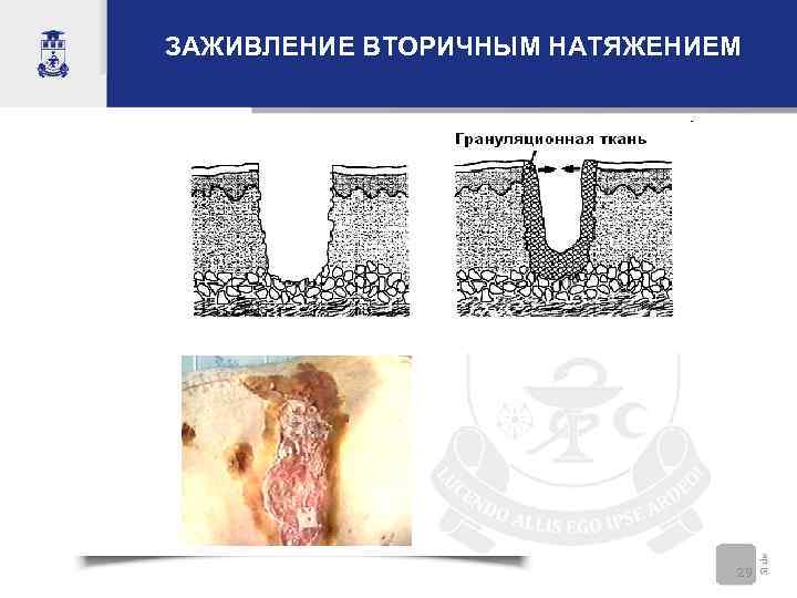 ЗАЖИВЛЕНИЕ ВТОРИЧНЫМ НАТЯЖЕНИЕМ 29 