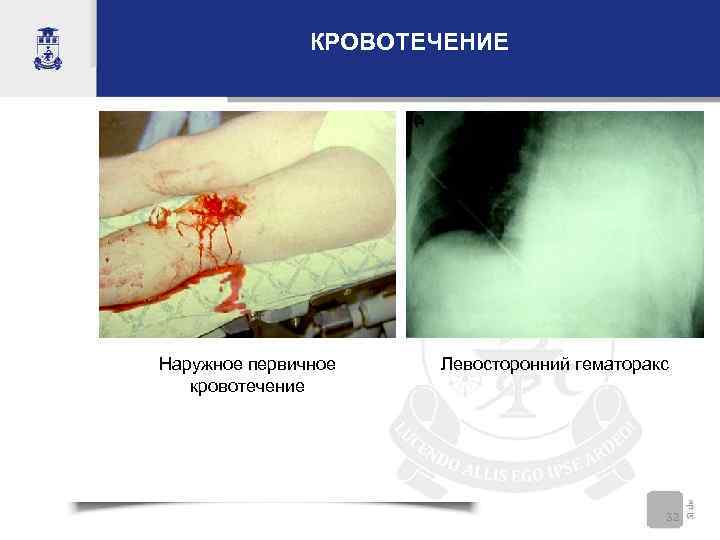 КРОВОТЕЧЕНИЕ Наружное первичное кровотечение Левосторонний гематоракс 32 