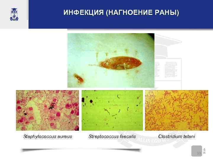 ИНФЕКЦИЯ (НАГНОЕНИЕ РАНЫ) Staphylococcus aureus Streptococcus faecalis Clostridium tetani 33 