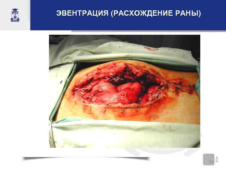 ЭВЕНТРАЦИЯ (РАСХОЖДЕНИЕ РАНЫ) 34 