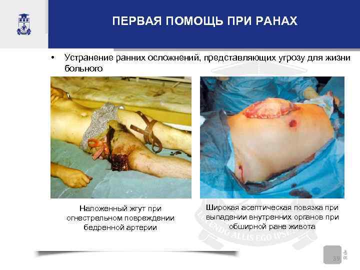 ПЕРВАЯ ПОМОЩЬ ПРИ РАНАХ • Устранение ранних осложнений, представляющих угрозу для жизни больного Наложенный