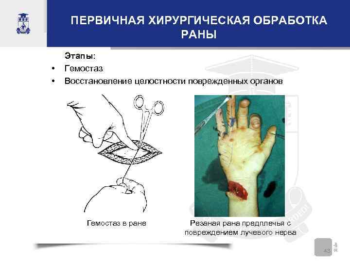 ПЕРВИЧНАЯ ХИРУРГИЧЕСКАЯ ОБРАБОТКА РАНЫ • • Этапы: Гемостаз Восстановление целостности поврежденных органов Гемостаз в