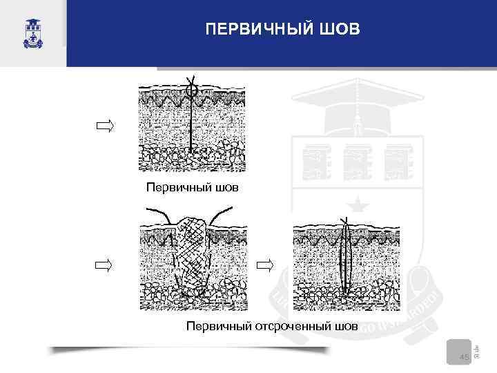 ПЕРВИЧНЫЙ ШОВ Первичный шов Первичный отсроченный шов 45 