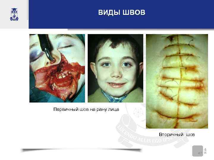 ВИДЫ ШВОВ Первичный шов на рану лица Вторичный шов 47 