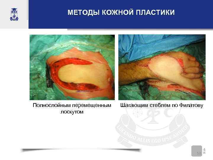 МЕТОДЫ КОЖНОЙ ПЛАСТИКИ Полнослойным перемещенным лоскутом Шагающим стеблем по Филатову 52 