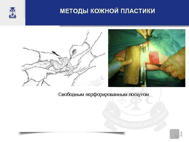МЕТОДЫ КОЖНОЙ ПЛАСТИКИ Свободным перфорированным лоскутом 53 