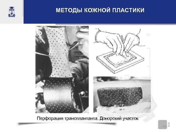 МЕТОДЫ КОЖНОЙ ПЛАСТИКИ Перфорация трансплантанта. Донорский участок 54 