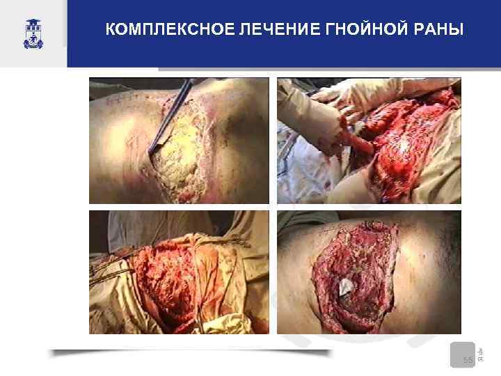 КОМПЛЕКСНОЕ ЛЕЧЕНИЕ ГНОЙНОЙ РАНЫ 55 