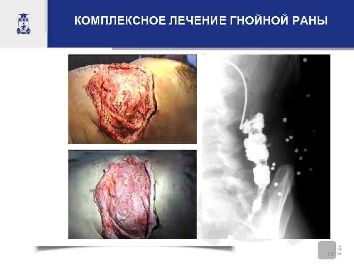 КОМПЛЕКСНОЕ ЛЕЧЕНИЕ ГНОЙНОЙ РАНЫ 56 