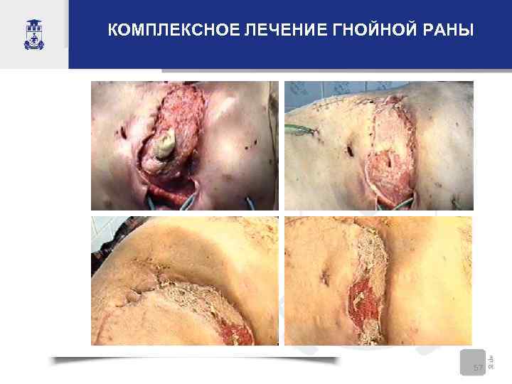 КОМПЛЕКСНОЕ ЛЕЧЕНИЕ ГНОЙНОЙ РАНЫ 57 