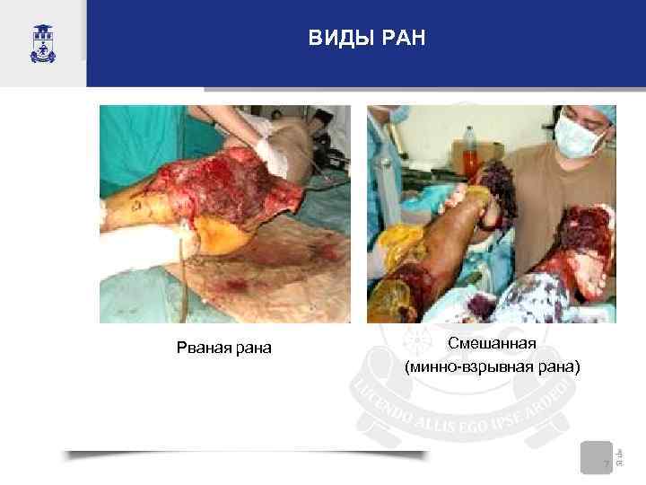 ВИДЫ РАН Рваная рана Смешанная (минно-взрывная рана) 7 