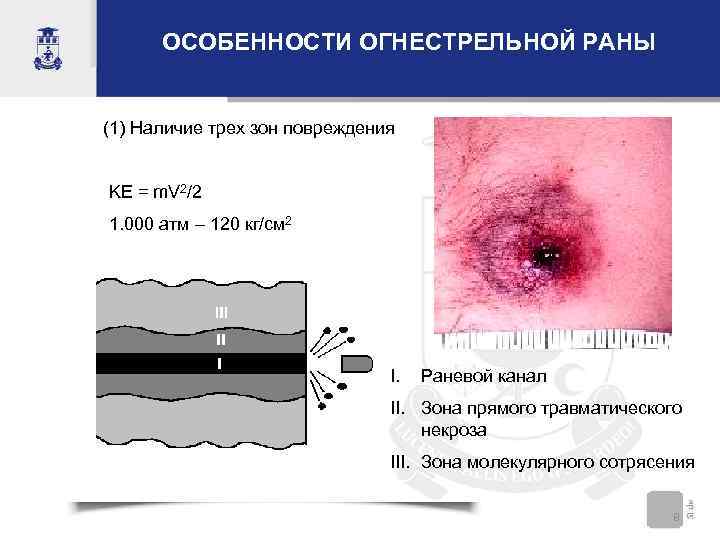 ОСОБЕННОСТИ ОГНЕСТРЕЛЬНОЙ РАНЫ (1) Наличие трех зон повреждения KE = m. V 2/2 1.