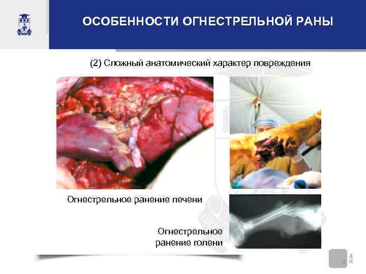 ОСОБЕННОСТИ ОГНЕСТРЕЛЬНОЙ РАНЫ (2) Сложный анатомический характер повреждения Огнестрельное ранение печени Огнестрельное ранение голени