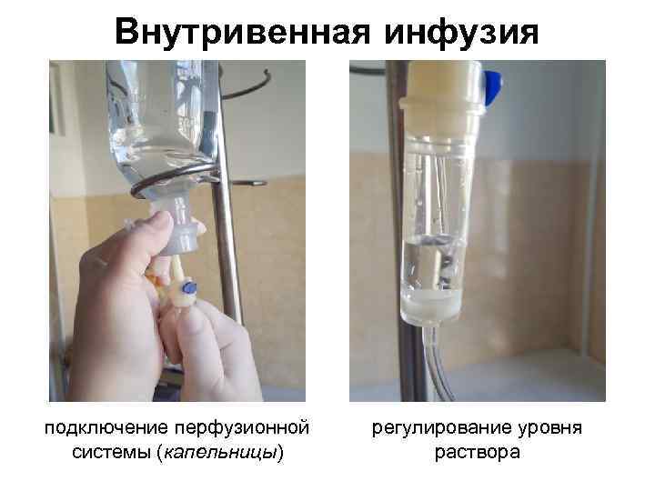 Внутривенная инфузия подключение перфузионной системы (капельницы) регулирование уровня раствора 