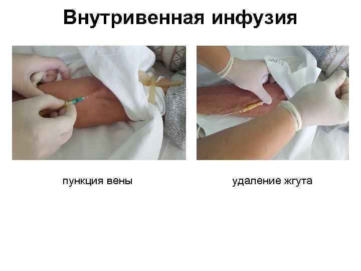 Внутривенная инфузия пункция вены удаление жгута 