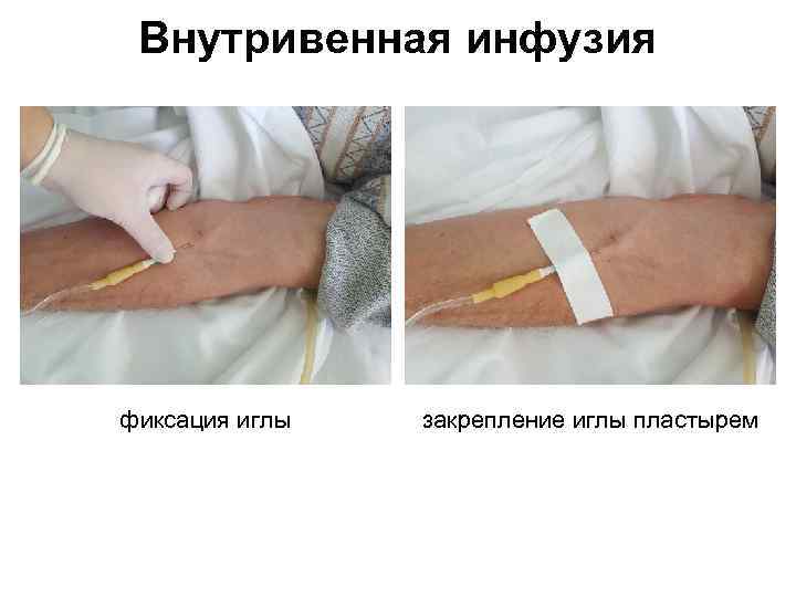Внутривенная инфузия фиксация иглы закрепление иглы пластырем 