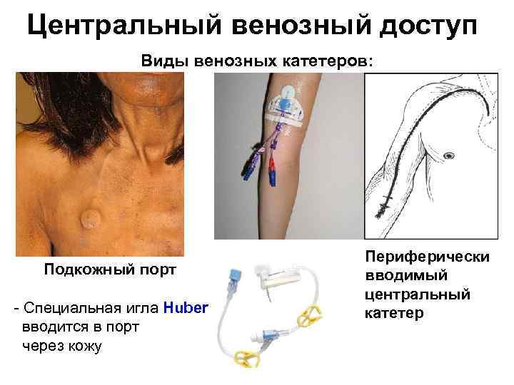 Центральный венозный доступ Виды венозных катетеров: Подкожный порт Специальная игла Huber вводится в порт