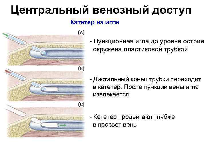 Центральный венозный доступ Катетер на игле Пункционная игла до уровня острия окружена пластиковой трубкой
