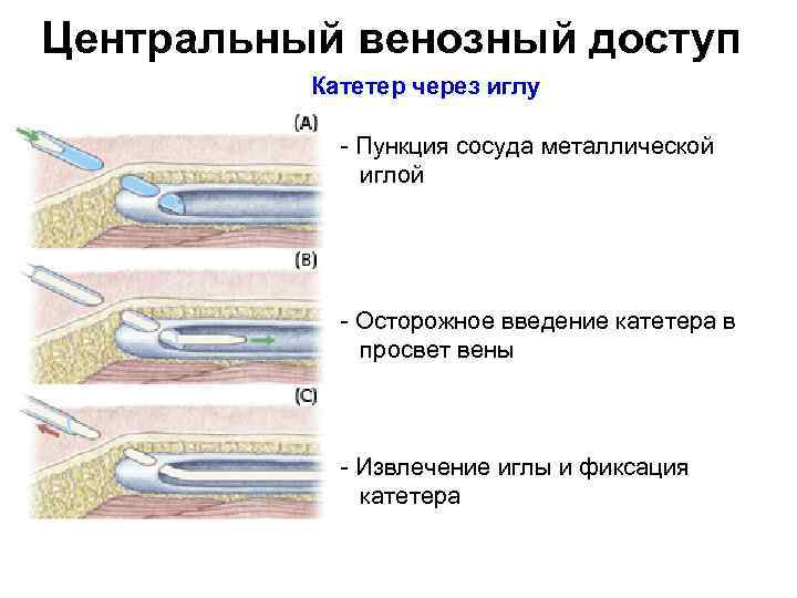 Центральный венозный доступ Катетер через иглу Пункция сосуда металлической иглой Осторожное введение катетера в