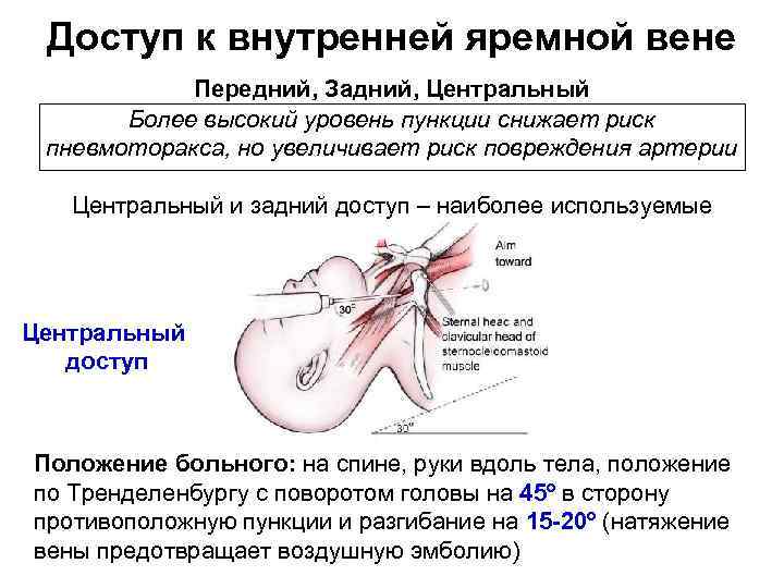 Доступ к внутренней яремной вене Передний, Задний, Центральный Более высокий уровень пункции снижает риск