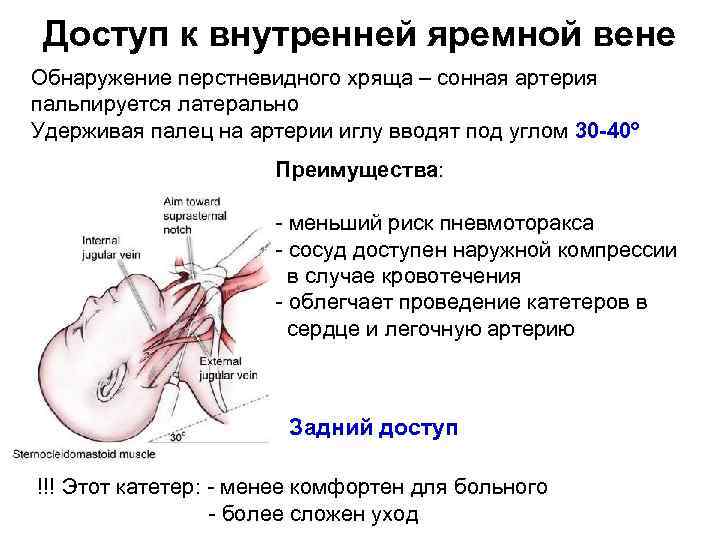 Доступ к внутренней яремной вене Обнаружение перстневидного хряща – сонная артерия пальпируется латерально Удерживая