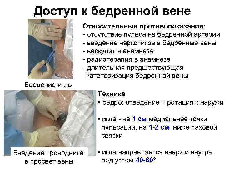 Доступ к бедренной вене Относительные противопоказания: отсутствие пульса на бедренной артерии введение наркотиков в
