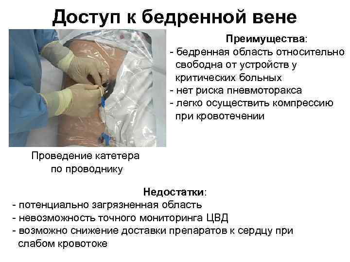 Доступ к бедренной вене Преимущества: бедренная область относительно свободна от устройств у критических больных