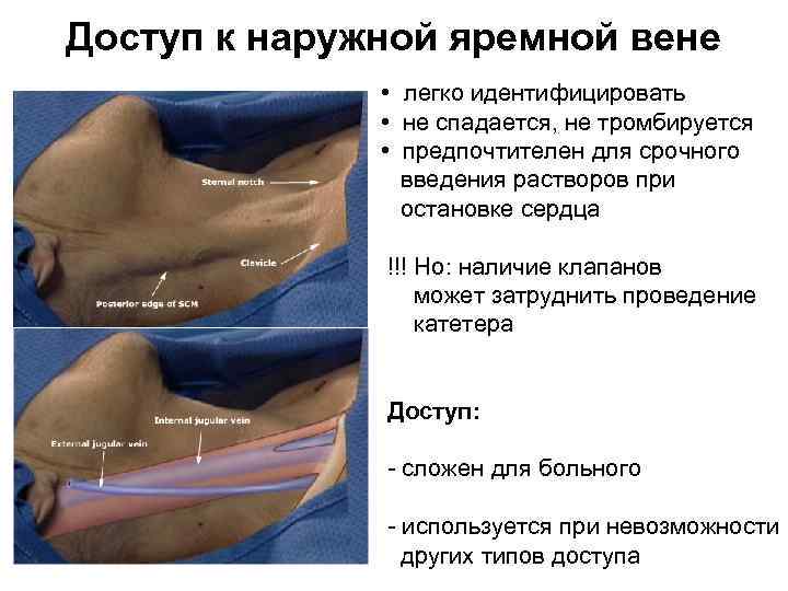 Доступ к наружной яремной вене • легко идентифицировать • не спадается, не тромбируется •