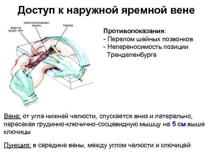Доступ к наружной яремной вене Противопоказания: Перелом шейных позвонков Непереносимость позиции Тренделенбурга Вена: от