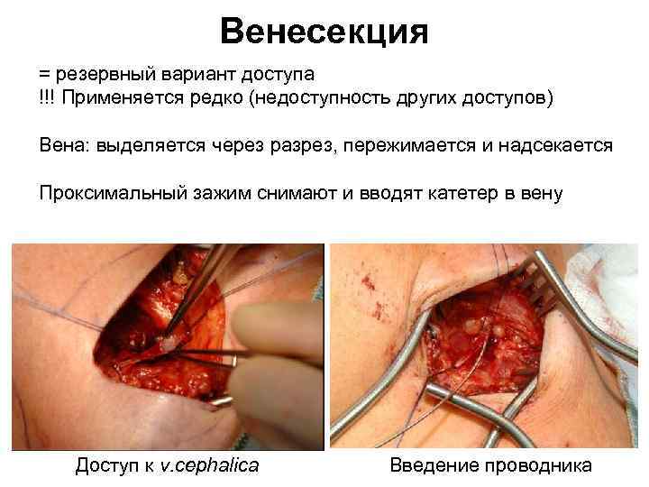 Венесекция = резервный вариант доступа !!! Применяется редко (недоступность других доступов) Вена: выделяется через