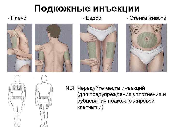 Подкожные инъекции Плечо Бедро Стенка живота NB! Чередуйте места инъекций (для предупреждения уплотнения и