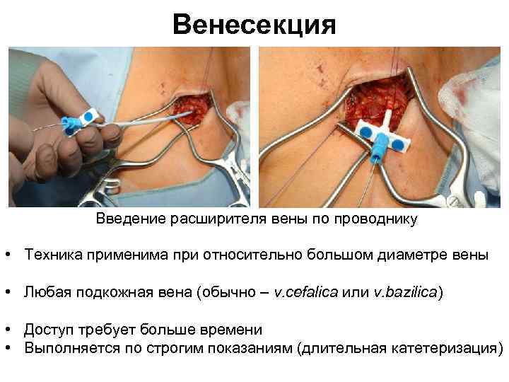 Венесекция Введение расширителя вены по проводнику • Техника применима при относительно большом диаметре вены