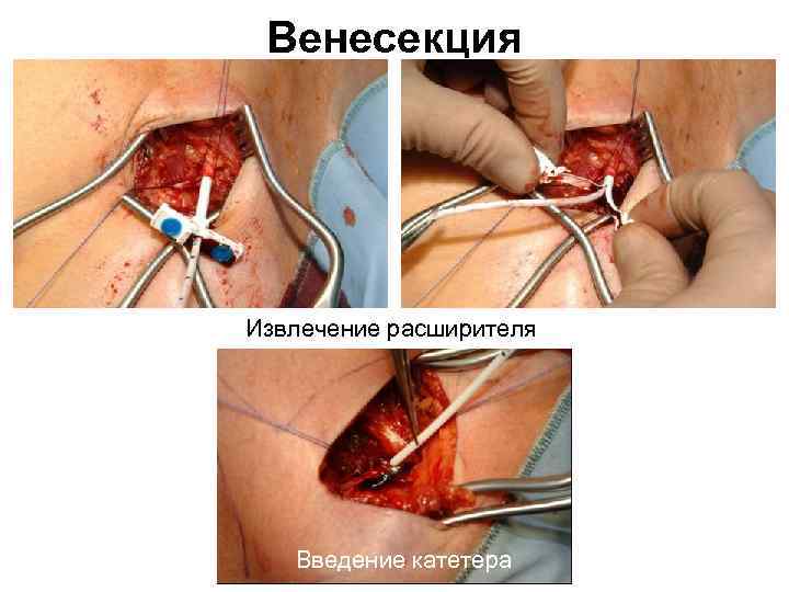 Венесекция Извлечение расширителя Введение катетера 