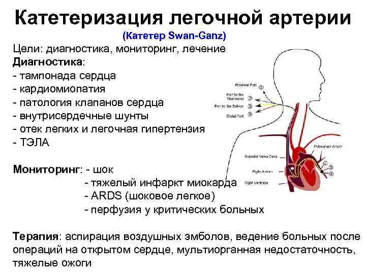 Катетеризация легочной артерии (Катетер Swan Ganz) Цели: диагностика, мониторинг, лечение Диагностика: тампонада сердца кардиомиопатия