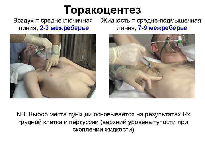 Торакоцентез Воздух = среднеключичная линия, 2 3 межреберье Жидкость = средне подмышечная линия, 7