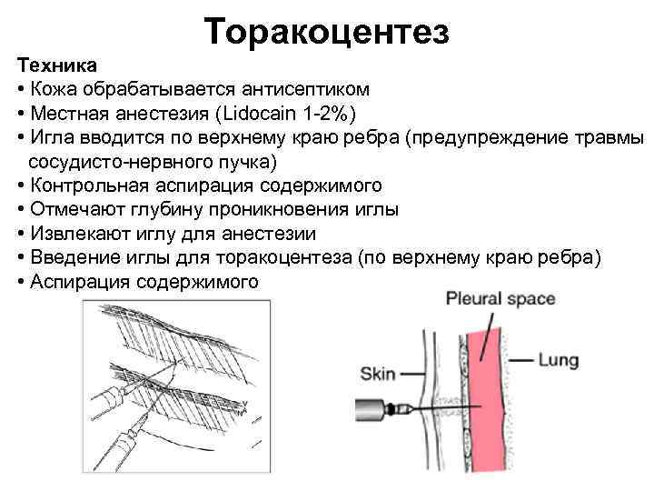 Торакоцентез Техника • Кожа обрабатывается антисептиком • Местная анестезия (Lidocain 1 2%) • Игла