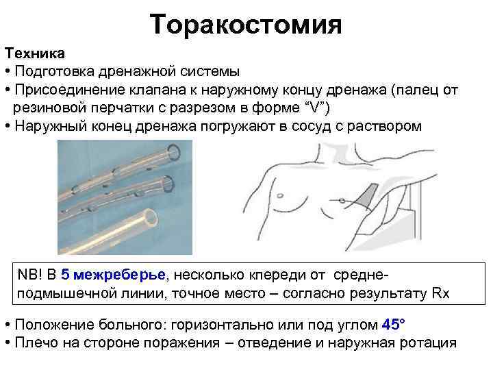 Торакостомия Техника • Подготовка дренажной системы • Присоединение клапана к наружному концу дренажа (палец