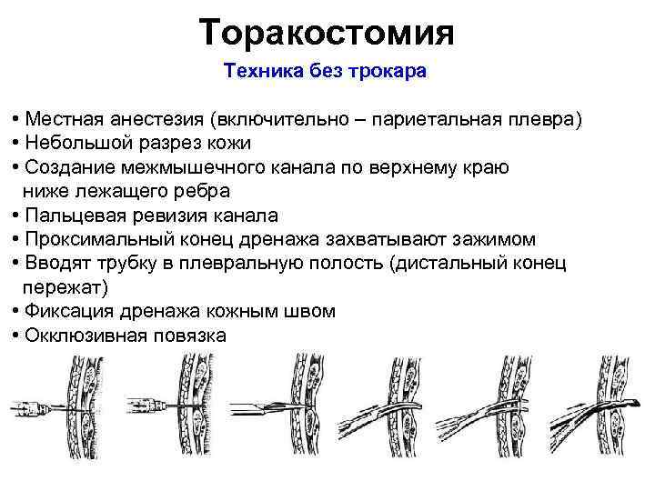 Торакостомия Техника без трокара • Местная анестезия (включительно – париетальная плевра) • Небольшой разрез