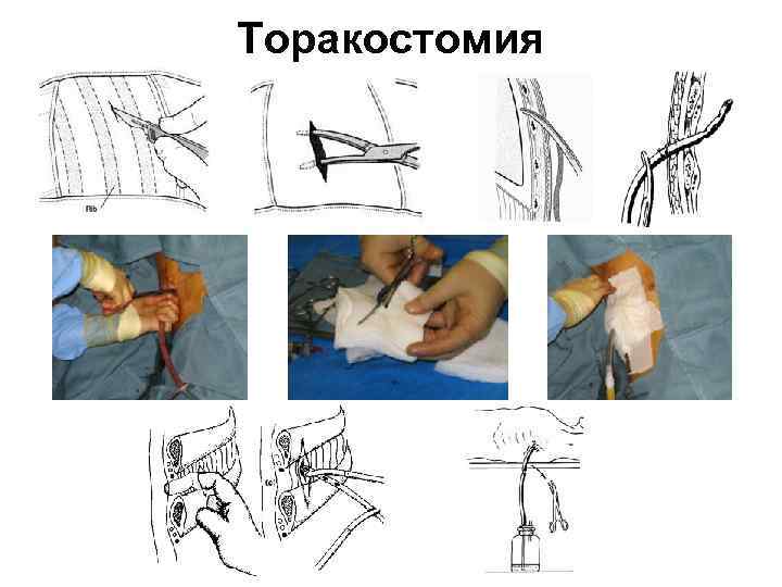 Торакостомия 