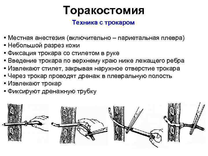 Торакостомия Техника с трокаром • Местная анестезия (включительно – париетальная плевра) • Небольшой разрез