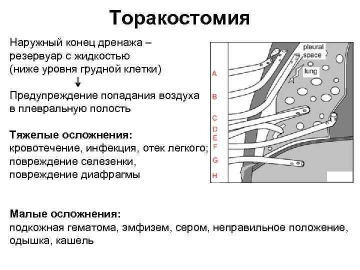 Торакостомия Наружный конец дренажа – резервуар с жидкостью (ниже уровня грудной клетки) Предупреждение попадания
