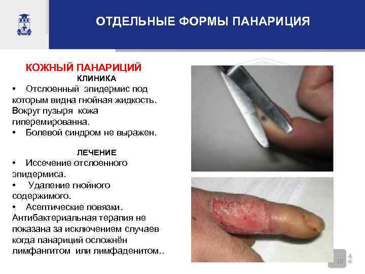 ОТДЕЛЬНЫЕ ФОРМЫ ПАНАРИЦИЯ КОЖНЫЙ ПАНАРИЦИЙ КЛИНИКА • Отслоенный эпидермис под которым видна гнойная жидкость.