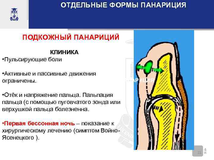 ОТДЕЛЬНЫЕ ФОРМЫ ПАНАРИЦИЯ ПОДКОЖНЫЙ ПАНАРИЦИЙ КЛИНИКА • Пульсирующие боли • Активные и пассивные движения