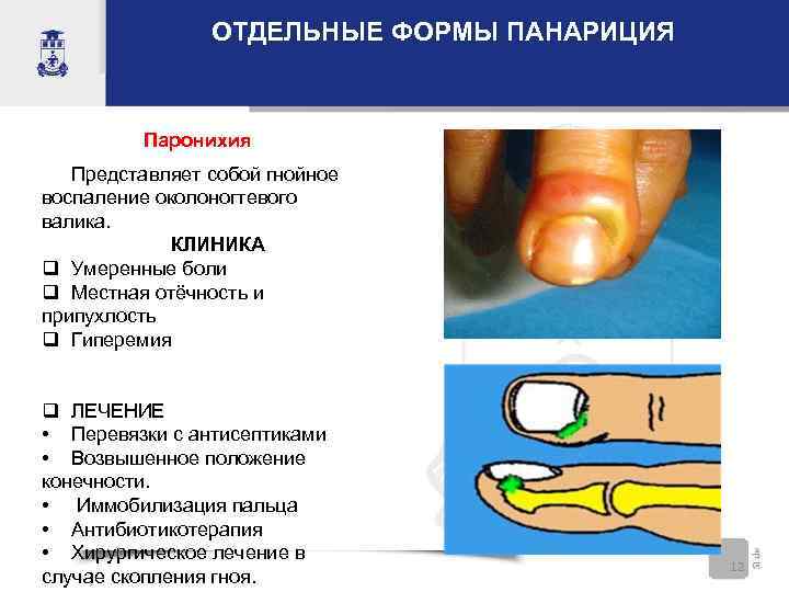 ОТДЕЛЬНЫЕ ФОРМЫ ПАНАРИЦИЯ Паронихия Представляет собой гнойное воспаление околоногтевого валика. КЛИНИКА q Умеренные боли