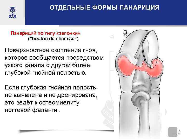 ОТДЕЛЬНЫЕ ФОРМЫ ПАНАРИЦИЯ Панариций по типу «запонки» (