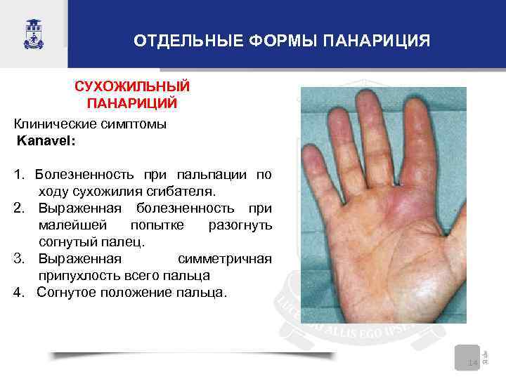 ОТДЕЛЬНЫЕ ФОРМЫ ПАНАРИЦИЯ СУХОЖИЛЬНЫЙ ПАНАРИЦИЙ Клинические симптомы Kanavel: 1. Болезненность при пальпации по ходу