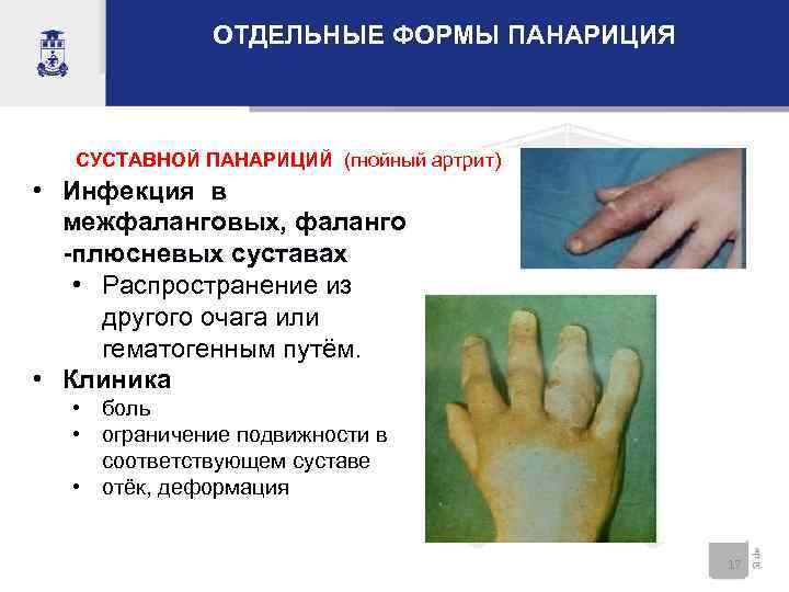 ОТДЕЛЬНЫЕ ФОРМЫ ПАНАРИЦИЯ СУСТАВНОЙ ПАНАРИЦИЙ (гнойный артрит) • Инфекция в межфаланговых, фаланго -плюсневых суставах