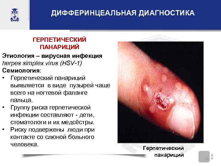 ДИФФЕРИНЦЕАЛЬНАЯ ДИАГНОСТИКА ГЕРПЕТИЧЕСКИЙ ПАНАРИЦИЙ Этиология – вирусная инфекция herpes simplex virus (HSV-1) Семиология: •